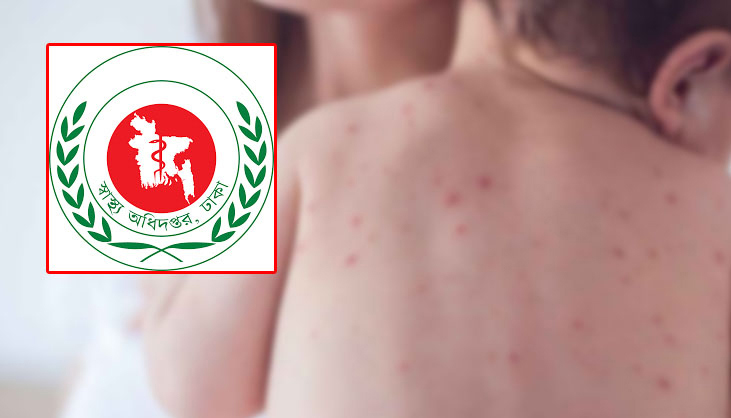 হাম উপসর্গে আরও ৫ শিশুর মৃত্যু