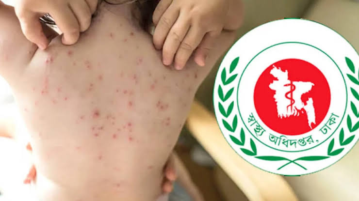 হাম উপসর্গে আরও ৩ শিশুর মৃত্যু
